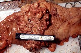 carcinoma colon rettale